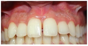 Gum Pigmentation