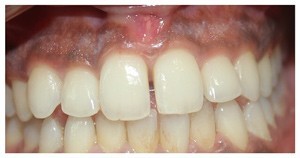 Gum Pigmentation