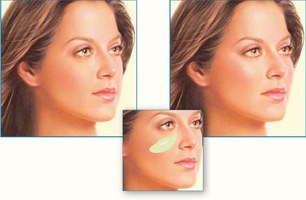 Cheek Implant
