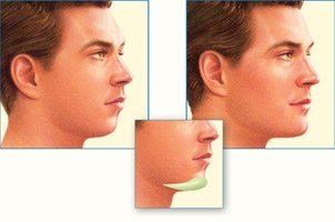 Chin Implant