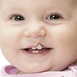 Cleft Lip and Palate Treatment
