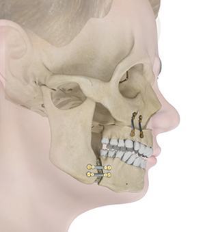 Correction of Facial Deformities