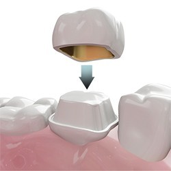 Complete Smile Makeover