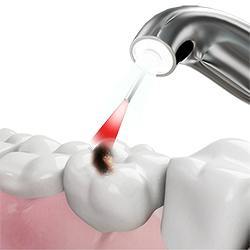 Dental Laser