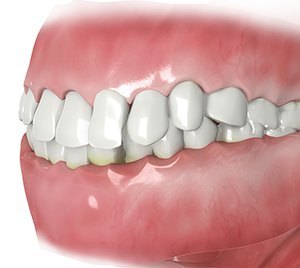 Dental Malocclusions