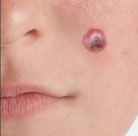 Facial Skin Lesions Removal