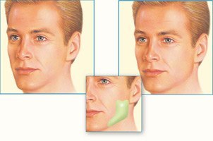 Jaw Implant