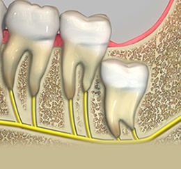 Surgical Removal of Impacted Teeth
