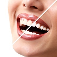 teeth-whitening